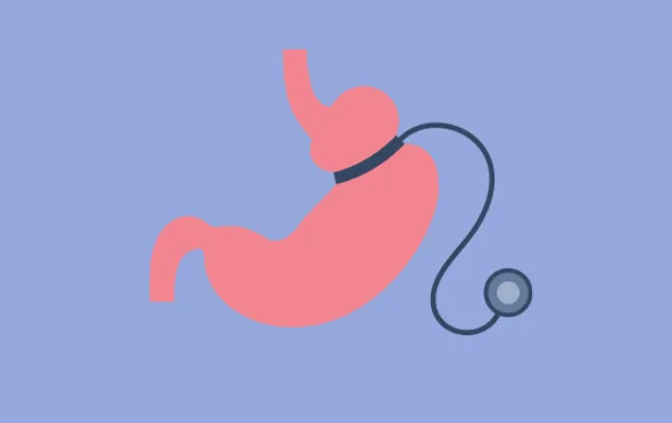 Schéma de l’anneau gastrique modulable placé autour de l’estomac