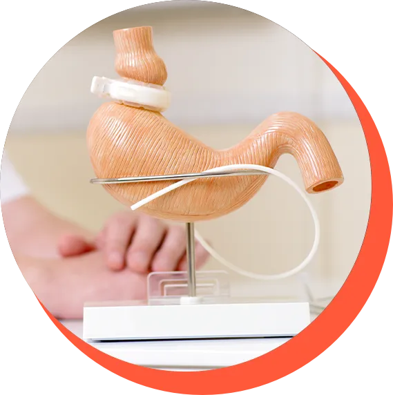 Schéma de la gastroplastie par anneau modulable