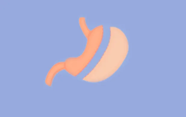 Schéma de la sleeve gastrectomie